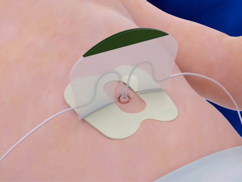 Soporte para Catéter Umbilical NeoBridge Grande N702 - Neotech Caja x20